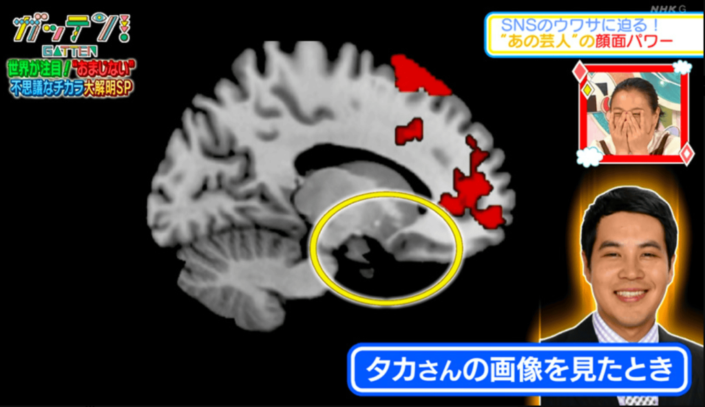 ガッテンで放送された、タカさんの側坐核の画像