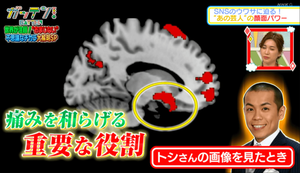 ガッテンで放送された、トシさんの側坐核の画像